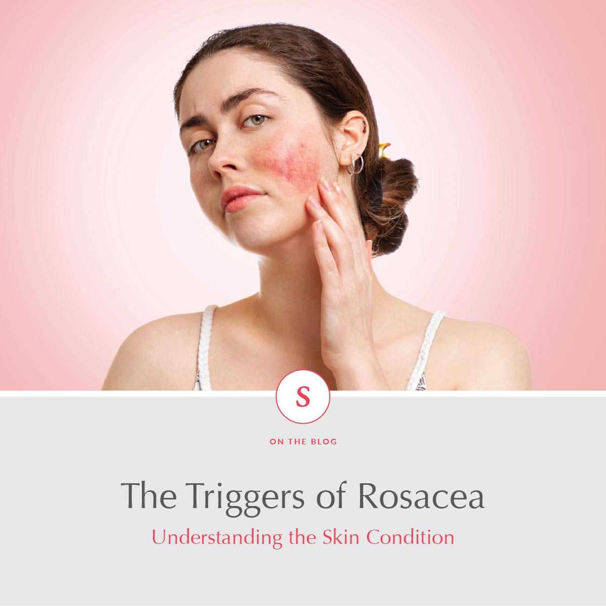 The Triggers of Rosacea: Understanding the Skin Condition
